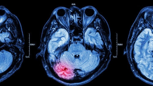 An MRI image of a brain with a red portion of the brain highlighted